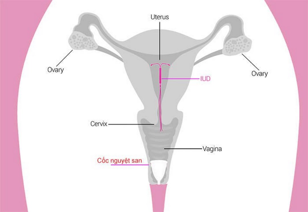 Hình ảnh cốc nguyệt san nằm trong tử cung người phụ nữ