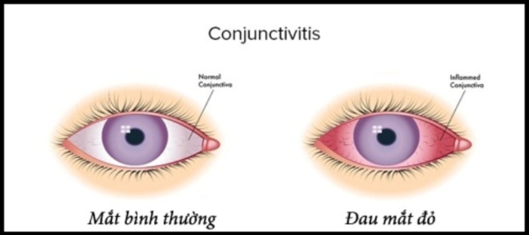 Học cách nhận diện bệnh đau mắt đỏ để dễ phòng tránh