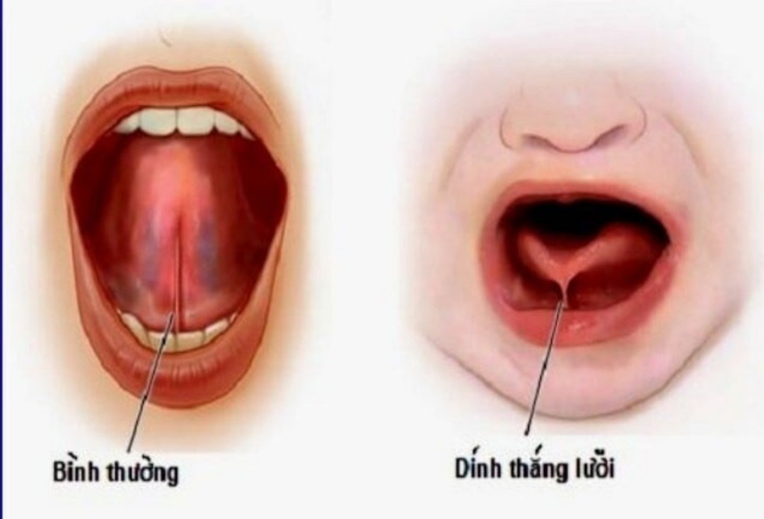 Dính thắng lưỡi - Một căn bệnh đơn thuần nhưng gây ảnh hưởng lớn