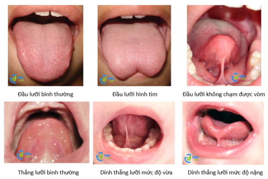 Một số mẫu và phân loại theo mức độ dính thắng lưỡi ở trẻ em