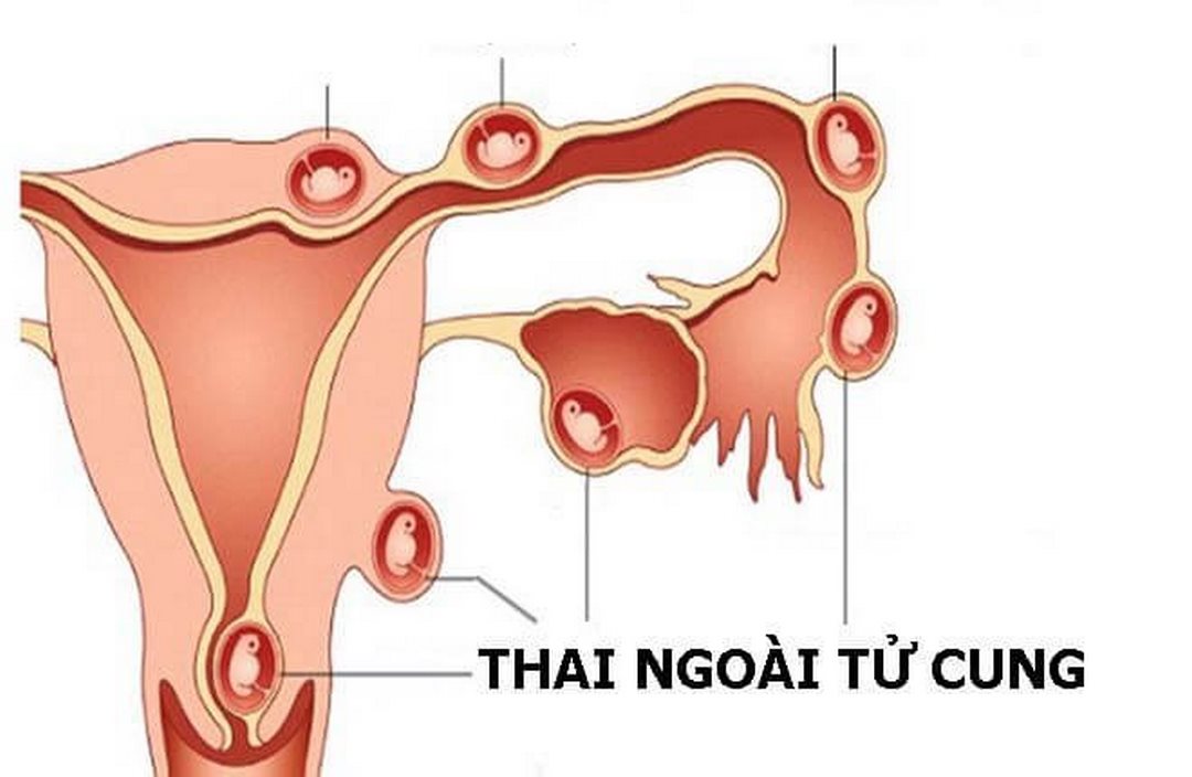 Mang thai ngoài tử cung còn có thể gây ra các cơn đau vùng bụng 