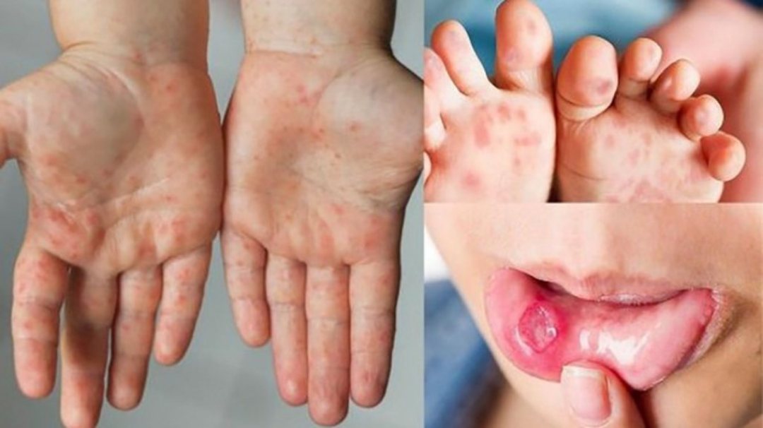 Những đặc điểm phát bệnh trên cơ thể của bệnh tay chân miệng ở trẻ