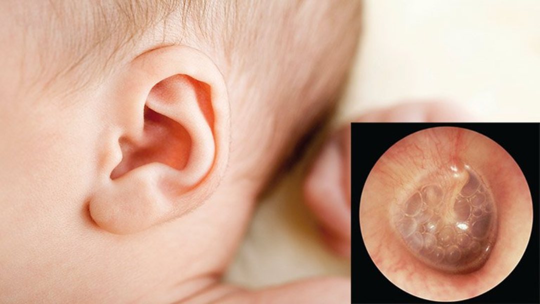 Viêm tai giữa là một loại bệnh dễ nhiễm phải ở trẻ em sơ sinh