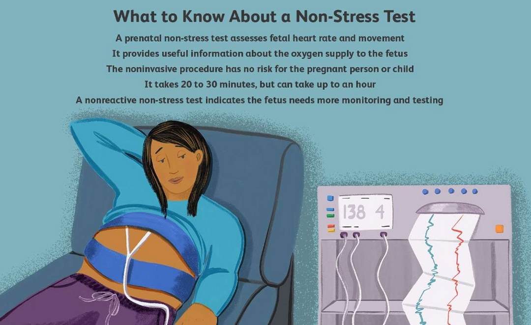 Xét nghiệm Non-stress test (NST)