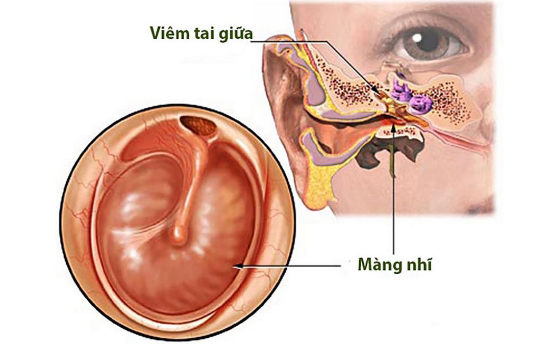 Nguyên nhân và triệu chứng của viêm tai giữa