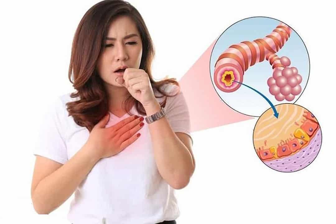 Bệnh viêm phế quản có nguy hiểm không?