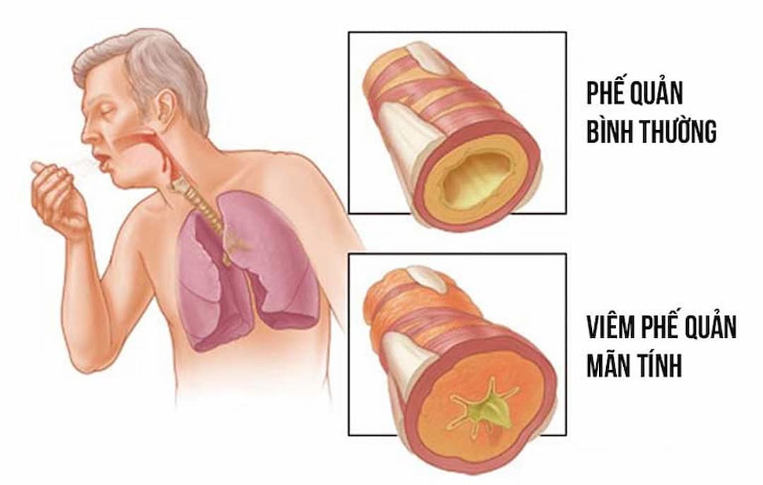 Các hướng dẫn sử dụng thuốc điều trị viêm phế quản
